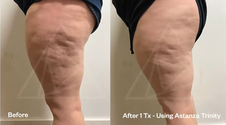 Cellulite treatment procedure